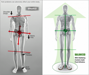 This is image of a person's body whose posture is tilted.  Flat feet can tilt your posture and cause your low back pain.