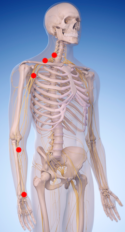 are pinched nerves same as bad vertebra in dogs