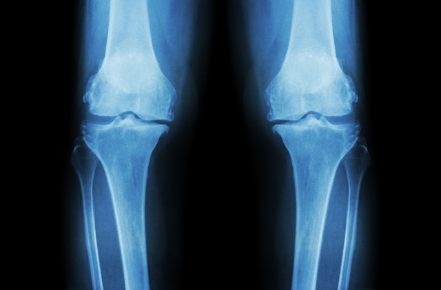 This is an x-ray of knee joints that have osteoarthritis.  Glucosamine sulphate is a supplement to help with pain relief and slow down the progression of osteoarthritis.