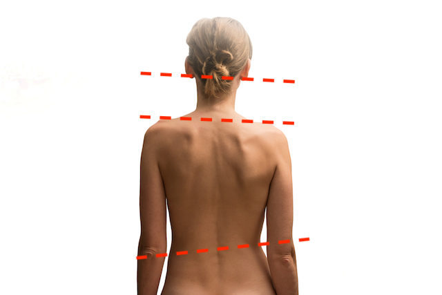 This is a picture of a back of woman where her posture is out of alignment.  The article talks about why your spine goes out of alignment.