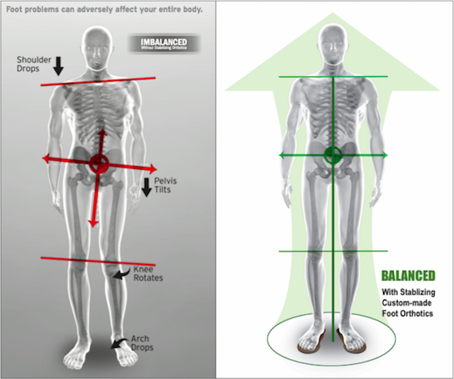 This is an image of posture being improved by custom foot orthotics.